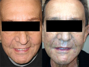 juvederm2