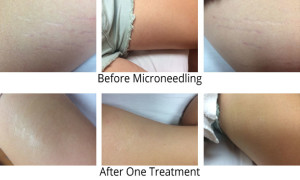 microneedling